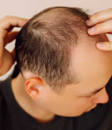 Hair loss